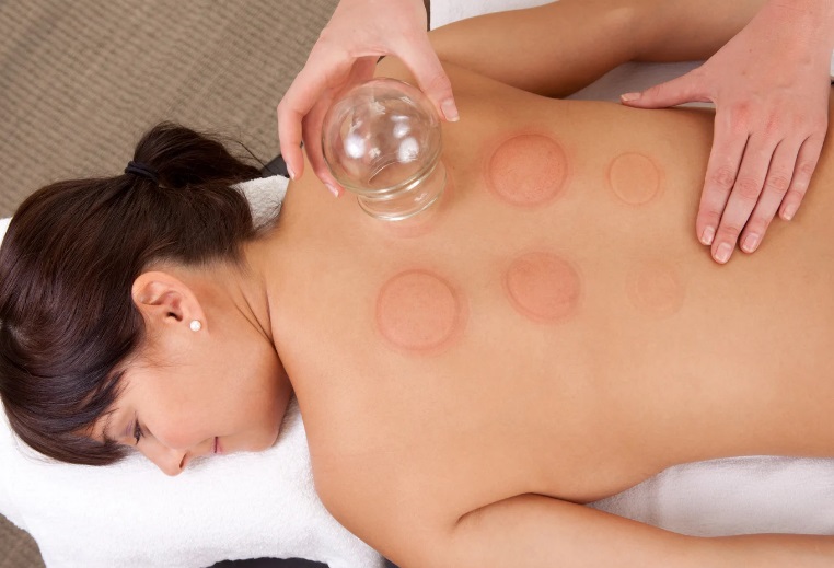 Cupping therapy treatment, Stirling